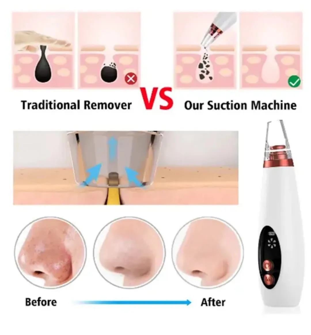 Electric Face Suction Removal Machine Pore Cleaner, blackhead , Whitehead , Soft Pimple , Oil Remover machine ( 5 Suction)